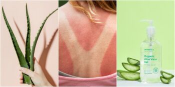 Tatiliniz Kabusa Dönüşmesin: Güneş Yanığına Ne İyi Gelir?