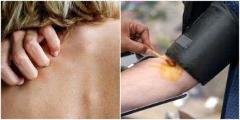 Oldukça Nadir Görülen İyot Alerjisi Nedir? Belirtileri Nelerdir?