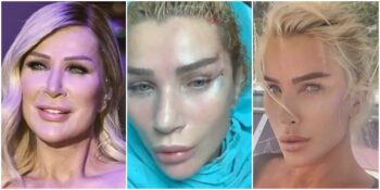 Ameliyatsız Yüz Gerdirme: Fransız Askısı Nedir? Nasıl Yapılır?