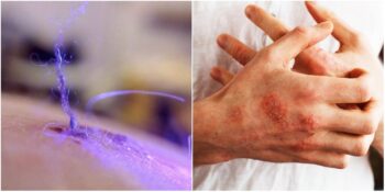 Ciltten Siyah, Mavi ya da Kırmızı Lifler Sarkmasın Sebep Olan Gizemli Hastalık: Morgellon Nedir?