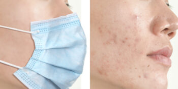 Günümüz Cilt Problemi Maskne: Maskne Nedir ve Nasıl Oluşur?