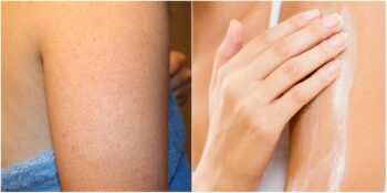 Keratosis Pilaris: Ciltte Tavuk Derisi Görünümü Nedir, Sebepleri Nelerdir?