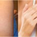 Keratosis Pilaris: Ciltte Tavuk Derisi Görünümü Nedir, Sebepleri Nelerdir?