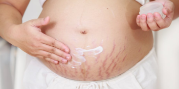 Gebelik Sonrası Çatlaklarla Nasıl Başa Çıkılır? En İyi Gebelik Sonrası Çatlak Kremleri