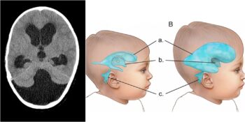 Nadir Görülen Bir Anomali: Dandy Walker Sendromu Nedir?