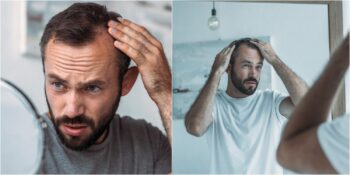 Erkeklerde Saç Dökülmesi: Saç Dökülmesi Neden Olur, Nasıl Önlenir?