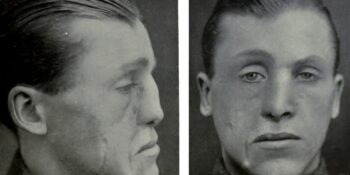 Modern Plastik Cerrahinin Doğuşu: Birinci Dünya Savaşı Gazilerine Yeniden Hayat Veren Estetik Ameliyatlar