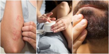 Egzamadan Seboreik Dermatite: Hassas Ciltler İçin En İyi Bakım ve Güzellik Ürünleri