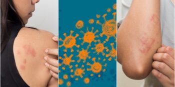 Covid-19’un Belirtilerine Bir Yenisi Daha Eklendi: Cilt Sorunları