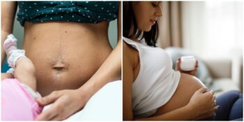 Anne Adayları Buraya! Hamileliğin Ardından Yaşanabilecek En Yaygın 5 Cilt Hastalığı