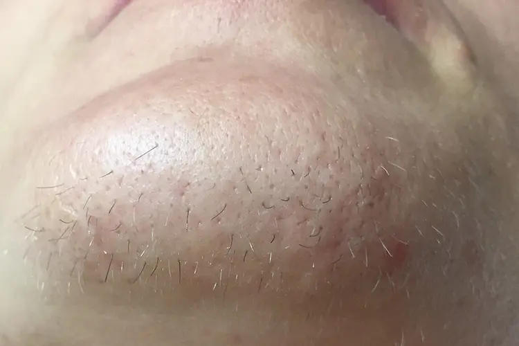 hirsutizm