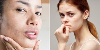 Sebum Nedir? Cildin Sebum Dengesi Hakkında Bilmeniz Gereken 5 Şey