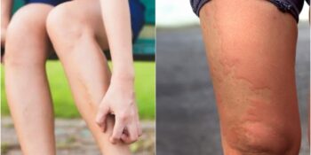 Bacaklarda Kızarıklık ve Kaşıntı Neden Olur, Nasıl Geçer?