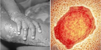 Hızla Yayılıyor! Avrupa ve Amerika Kıtalarında Görülen Maymun Çiçeği Hastalığı Nedir?