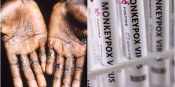 Maymun Çiçeği Virüsü: Endişelenmeli Miyiz, Yeni Bir Pandemi İhtimali Var Mı?