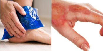 Buz Yanığı Nedir? Vücudunuza Soğuk Kompres Uygularken Nelere Dikkat Etmelisiniz?