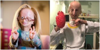 Erken Yaşlanma Hastalığı Olarak Da Bilinen Progeria Sendromu Hakkında Bilmeniz Gerekenler