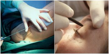 Plastik Cerrahi İle İlgili Muhtemelen Daha Önce Duymadığınız 8 Gerçek