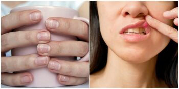 Çatlamış Dudaklardan Sararmış Bir Cilde: Ciddi Rahatsızlıkları Erkenden Fark Etmenizi Sağlayacak 8 İşaret