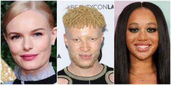 Eşsiz Genetik Özellikleriyle Diğer İnsanlardan Ayrılan Dünyaca Ünlü 9 İsim