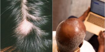 Tek Bir Kimyasal Sorumlu! Bilim İnsanları Kelliğin Muhtemel Çözümünü Keşfetti