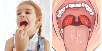 Bağışıklık Sistemimizin Önemli Bir Parçası Olan Bademcik Nedir, Ne İşe Yarar?