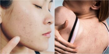 Vücudun Farklı Bölgelerinde Oluşan Akneler Sağlığınız Ve Yaşam Tarzınız Hakkında Ne Anlatıyor?