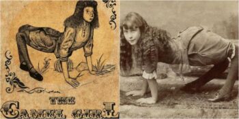 Nadir Görülen Hastalığı Nedeniyle Deve Kız Olarak İsimlendirilen Ella Harper’ın Yürek Burkan Hikayesi