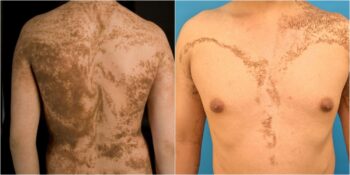 Blaschko Çizgileri: İnsan Vücudunun Çıplak Gözle Görülemeyen Gizemli Deri Lekeleri