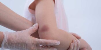 En Yaygın Cilt Problemlerinden Biri! Vücutta Morarma Neden Olur, Nasıl Geçer?