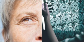 Tıp Dünyasında Devrim! Alzheimer Hastalığının Beyindeki Tahribatını Yavaşlatan İlaç Geliştirildi