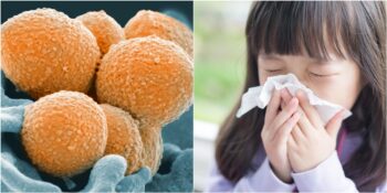 Avrupa’da Yeni Bir Salgın Endişesine Neden Olan Bakteri: Strep A Nedir?