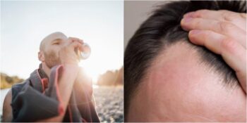 Bilim İnsanları Açıkladı: Şekerli İçecek Tüketen Erkeklerde Kellik Riski Daha Yüksek