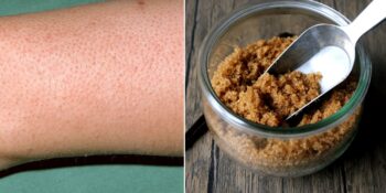 Sağlıklı Ve Pürüzsüz Bir Cilde Sahip Olmak İsteyenlere: Tavuk Derisi Görünümü Nedir, Nasıl Geçer?