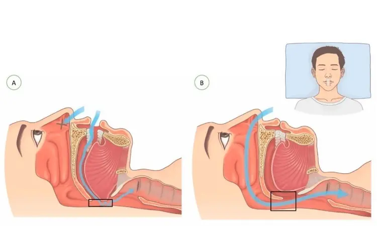 Mouth taping