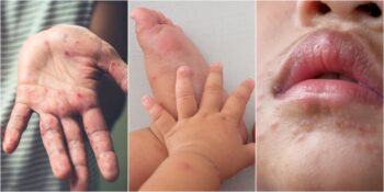 Uzmanların Vakalarda Artış Var Dediği El, Ayak ve Ağız Hastalığı Nedir, Belirtileri Nelerdir?