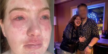 Erkek Arkadaşına Alerjisi Olan Kadın: Virginia Nault’un İlginç Hikayesi