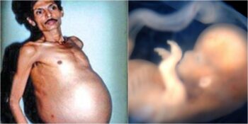 İkiz Kardeşini 36 Yıl Boyunca Karnında Taşıyan Adam: Sanju Bhagat