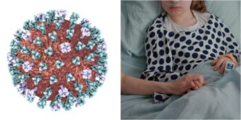 Kızamık Virüsünün Neden Olduğu Ölümcül Hastalık: SSPE Nedir, Belirtileri Nelerdir?