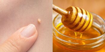 Siğillere Elveda! Daha Sağlıklı Bir Cilt Görünümü İçin 7 Doğal Yöntem