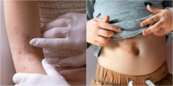 Uzmanlar Artan Uyuz Vakalarına Karşı Uyarıyor! Peki Dikkat Edilmesi Gerekenler Neler?