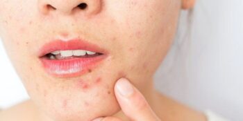 Yetişkinlik Döneminde Cildinizde Akne Çıkmasının 9 Nedeni
