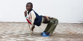 Vücudun “Katlanmasına” Neden Olan Sıra Dışı Bir Hastalık: Kuadriseps Kontraktürü Nedir?