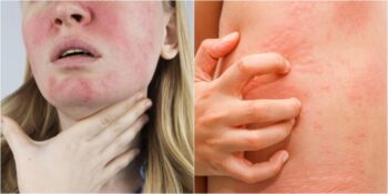 Kış Aylarında Ortaya Çıkan Cilt Hastalığı: Soğuk Alerjisi Nedir, Belirtileri Nelerdir?