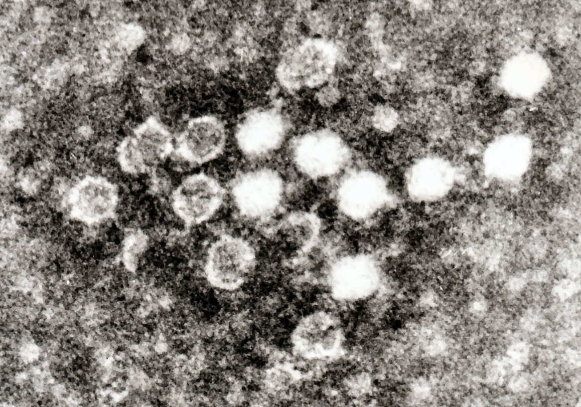 Parvovirüs B19