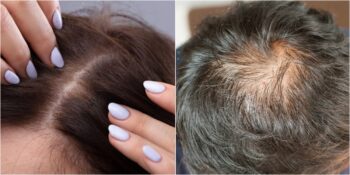 Kafada Sivilce Neden Çıkar, Tedavi Yöntemi Nedir, Nasıl Geçer?