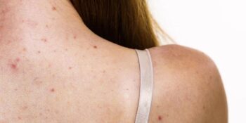 Yaygın Bir Cilt Problemi Olan Sivilce Neden Sırtta Çıkar, Nasıl Geçer?