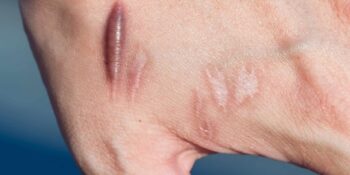 Nedir, Neden Oluşur, Nasıl Önlenir? Keloid Hakkında Bilmeniz Gereken Her Şey