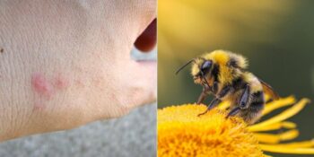 Yaz Aylarının Kabusu! Böcek Sokması Belirtileri Nelerdir, Ne İyi Gelir?