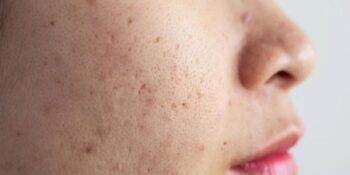 Dermatologlara Göre Cilt Lekelerinden Kurtulmanın 8 Etkili Yolu